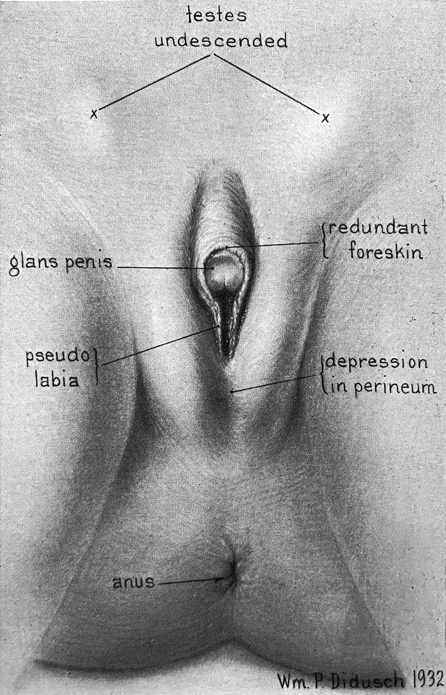 Medical illustration accompanying the case study portrays “testes undescended,” “glans penis,” “redundant foreskin,” and “pseudo labia.”